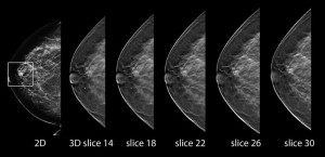 mammogramm