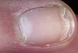 Lõhenenud küüned Foto: WebMD