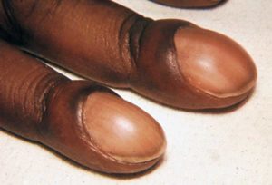 "Nuiasarnased" küüned Foto: WebMD
